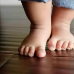تشخیص صافی کف پا درکودکان