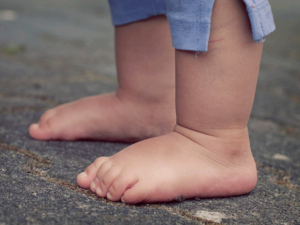 سن درمان صافی کف پا