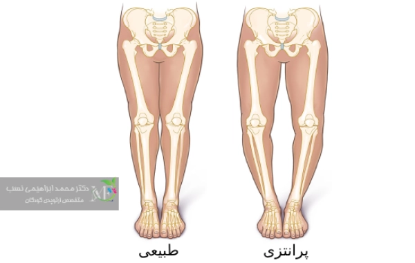 پای پرانتزی در کودکان