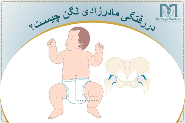 دررفتگی مادرزادی لگن چیست؟