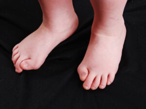 انحراف شست پا در کودکان