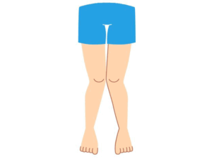 درمان زانوی ضربدری در کودکان