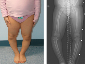 پای پرانتزی در کودکان