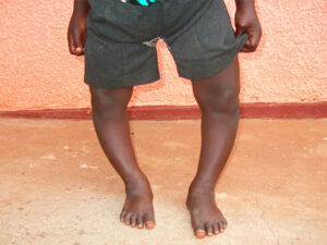 بیماری بلانت