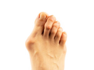 هالوکس والگوس