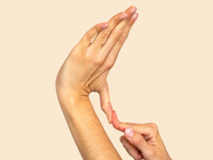 سندرم مارفان