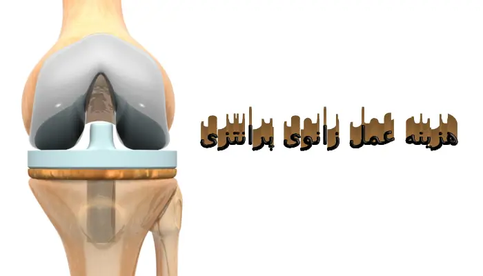 هزینه عمل زانوی پرانتزی