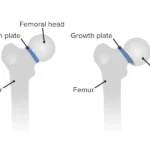 Slipped capital femoral epiphysis