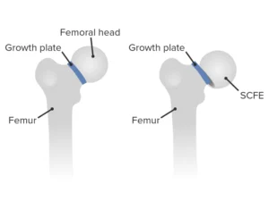 Slipped capital femoral epiphysis