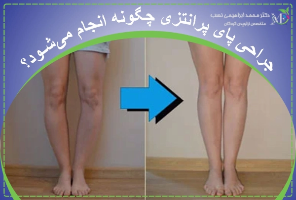 جراحی پای پرانتزی چگونه انجام میشود؟