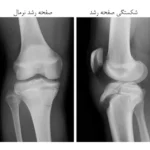 شکستگی صفحه رشد چیست؟