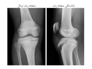 شکستگی صفحه رشد چیست؟