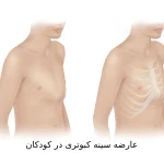 سینه کبوتری یا برآمدگی قفسه سینه در کودکان چیست؟
