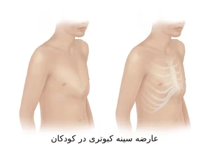 سینه کبوتری یا برآمدگی قفسه سینه در کودکان چیست؟