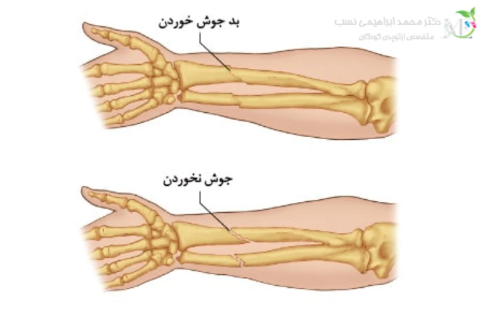 بد جوش خوردن استخوان شکسته به چه معناست؟