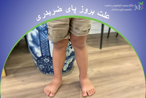 علت بروز پای ضربدری