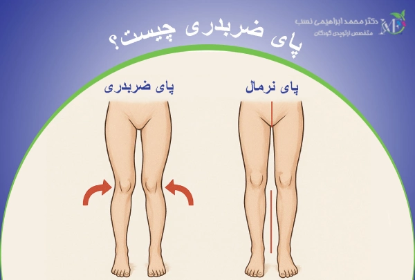 پای ضربدری چیست؟