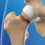 Hip fracture in children