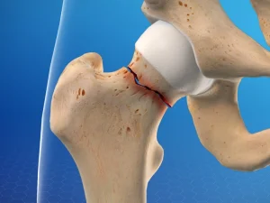 Hip fracture in children