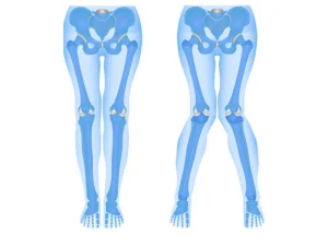 جراحی پای ضربدری