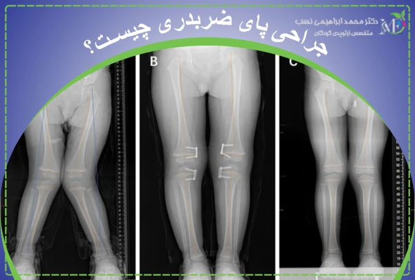 جراحی پای ضربدری چیست؟