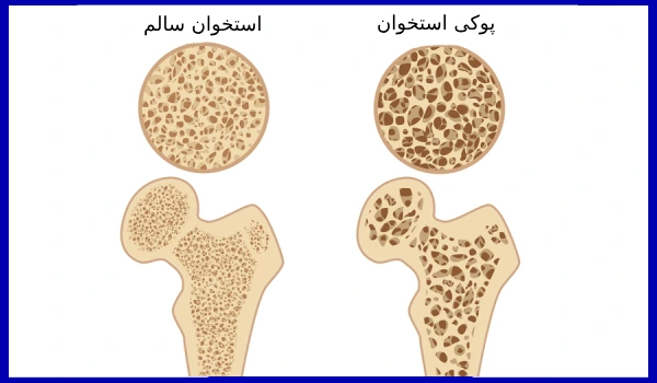 پوکی استخوان