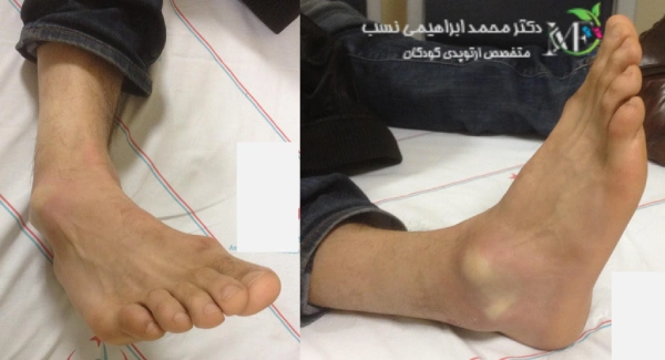 دررفتگی مچ پا 