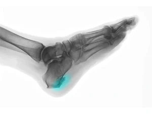 خار پاشنه در کودکان