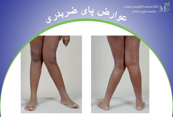 عوارض پای ضربدری