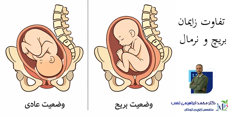 زایمان بریچ چیست و چه تاثیر بر نوزاد دارد؟